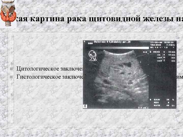 Цитологическая картина папиллярной карциномы щитовидной железы