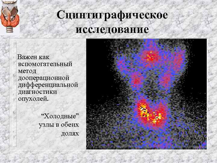 Сцинтиграфическое исследование Важен как вспомогательный метод дооперационной дифференциальной диагностики опухолей. “Холодные” узлы в обеих