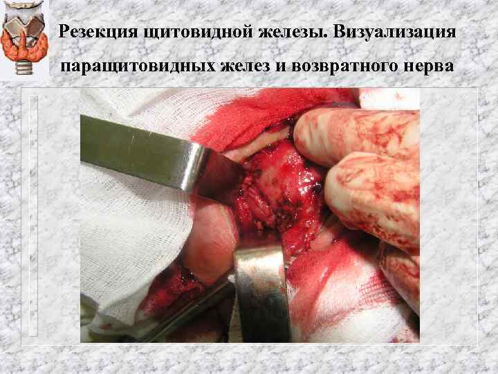 Резекция щитовидной железы. Визуализация паращитовидных желез и возвратного нерва 