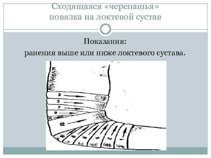 Сходящаяся «черепашья» повязка на локтевой сустав Показания: ранения выше или ниже локтевого сустава. 