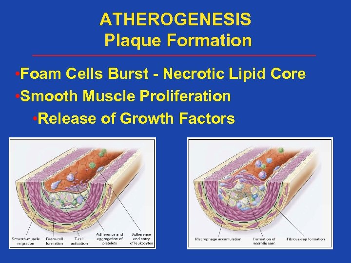 ATHEROGENESIS Plaque Formation • Foam Cells Burst - Necrotic Lipid Core • Smooth Muscle