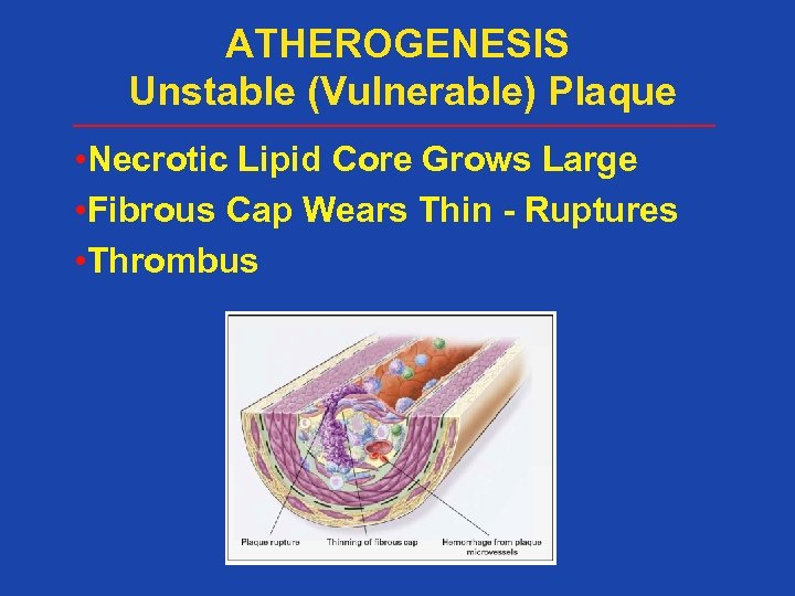 ATHEROGENESIS Unstable (Vulnerable) Plaque • Necrotic Lipid Core Grows Large • Fibrous Cap Wears