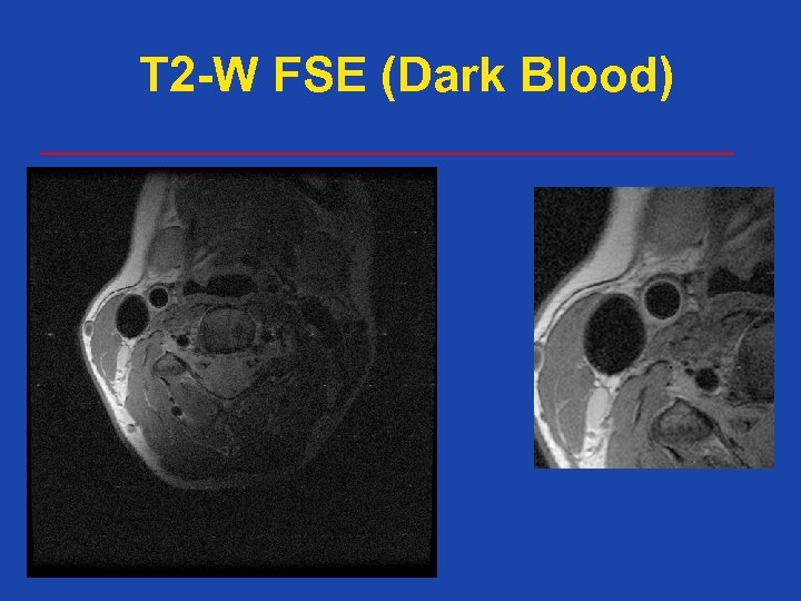 T 2 -W FSE (Dark Blood) 