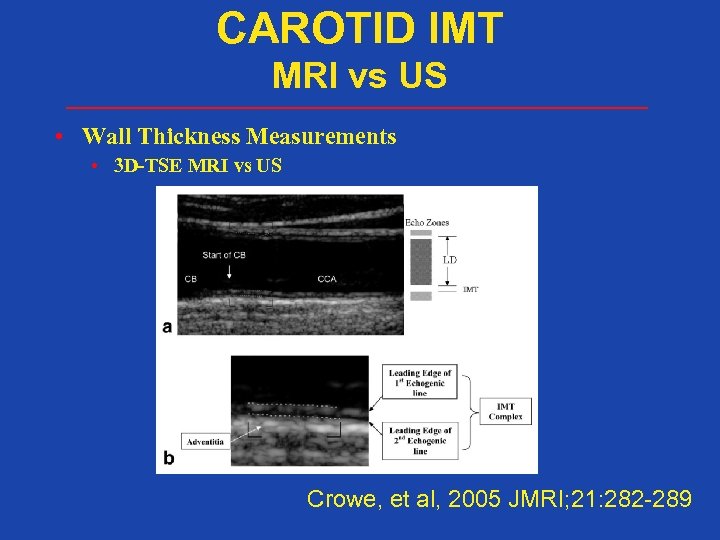 CAROTID IMT MRI vs US • Wall Thickness Measurements • 3 D-TSE MRI vs