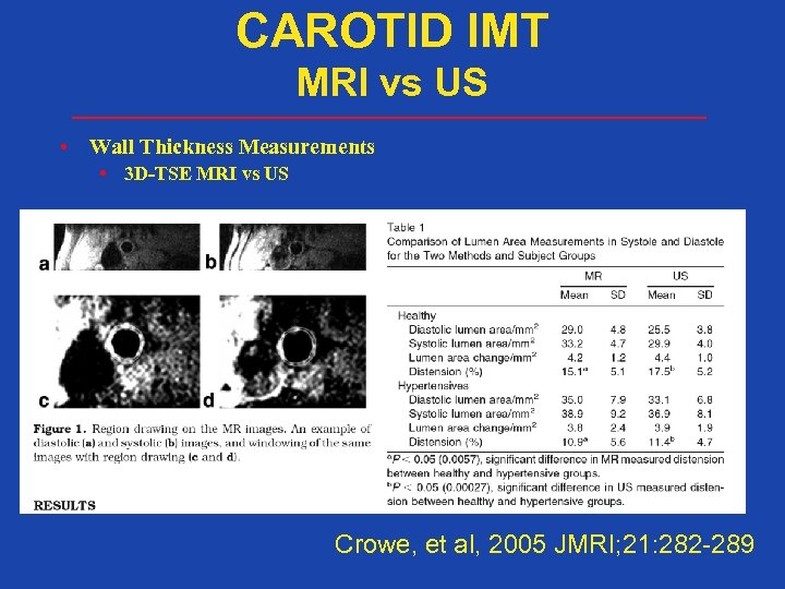 CAROTID IMT MRI vs US • Wall Thickness Measurements • 3 D-TSE MRI vs