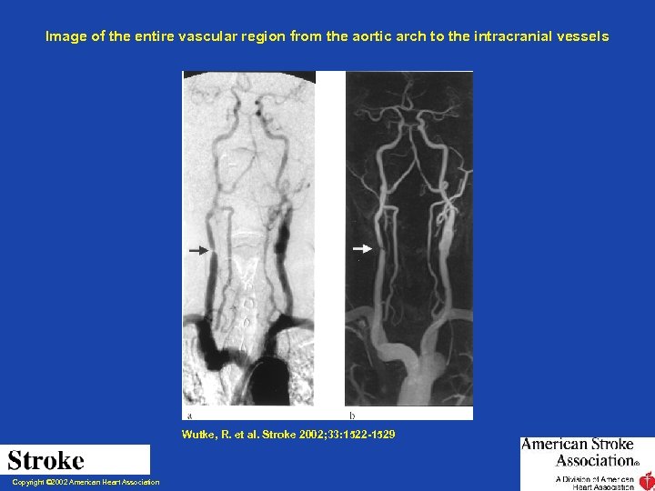 Image of the entire vascular region from the aortic arch to the intracranial vessels