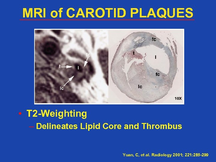 MRI of CAROTID PLAQUES • T 2 -Weighting – Delineates Lipid Core and Thrombus