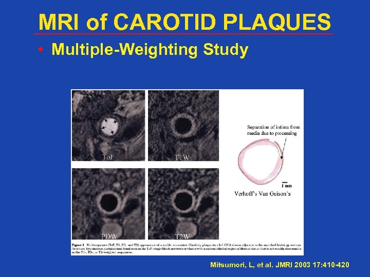 MRI of CAROTID PLAQUES • Multiple-Weighting Study Mitsumori, L, et al. JMRI 2003 17: