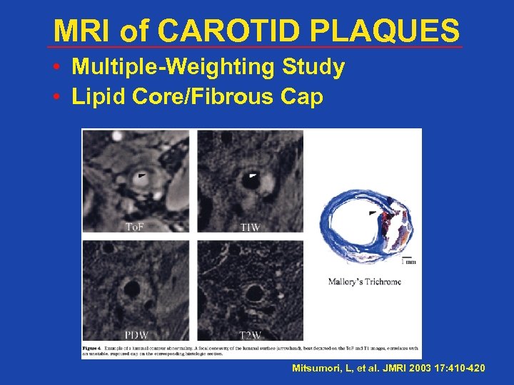 MRI of CAROTID PLAQUES • Multiple-Weighting Study • Lipid Core/Fibrous Cap Mitsumori, L, et