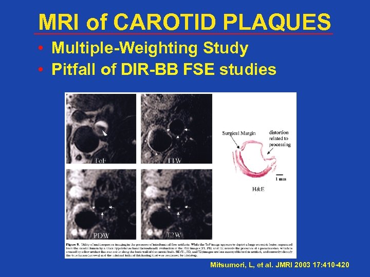 MRI of CAROTID PLAQUES • Multiple-Weighting Study • Pitfall of DIR-BB FSE studies Mitsumori,