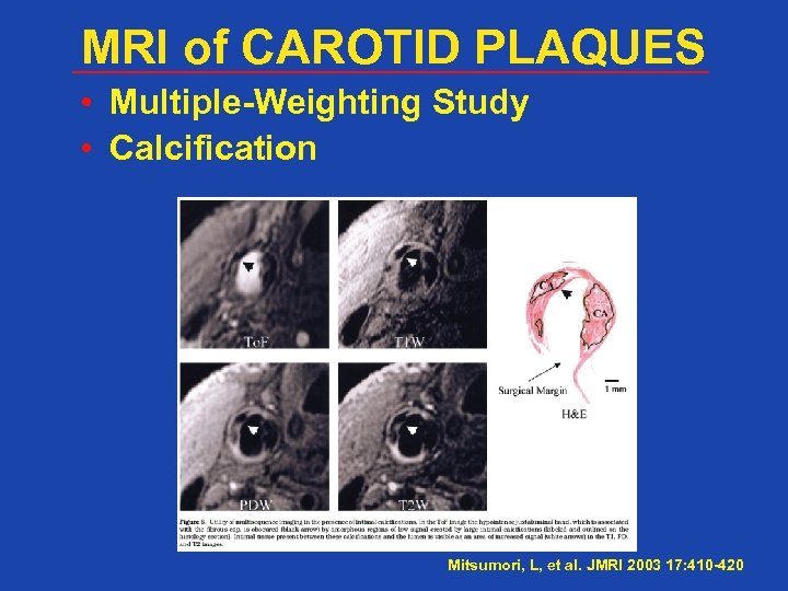 MRI of CAROTID PLAQUES • Multiple-Weighting Study • Calcification Mitsumori, L, et al. JMRI