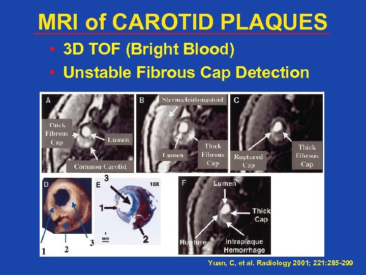 MRI of CAROTID PLAQUES • 3 D TOF (Bright Blood) • Unstable Fibrous Cap