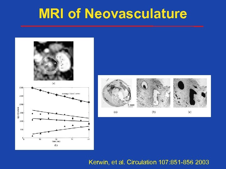 MRI of Neovasculature Kerwin, et al. Circulation 107: 851 -856 2003 