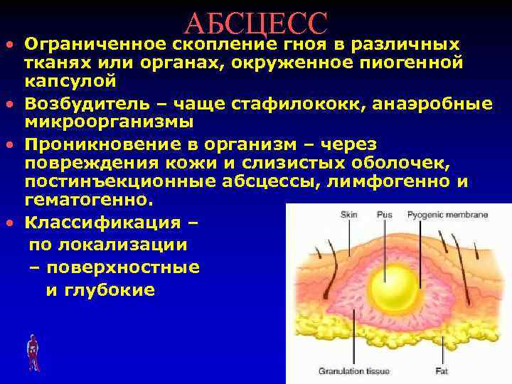 АБСЦЕСС • Ограниченное скопление гноя в различных тканях или органах, окруженное пиогенной капсулой •