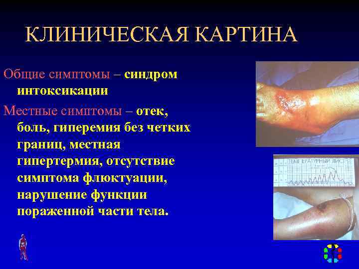 КЛИНИЧЕСКАЯ КАРТИНА Общие симптомы – синдром интоксикации Местные симптомы – отек, боль, гиперемия без