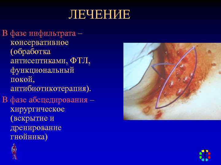 ЛЕЧЕНИЕ В фазе инфильтрата – консервативное (обработка антисептиками, ФТЛ, функциональный покой, антибиотикотерапия). В фазе