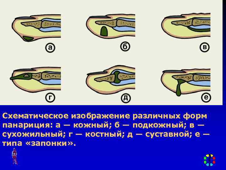 Схематическое изображение различных форм панариция: а — кожный; б — подкожный; в — сухожильный;