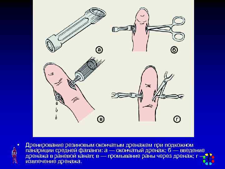  • Дренирование резиновым окончатым дренажем при подкожном панариции средней фаланги: а — окончатый