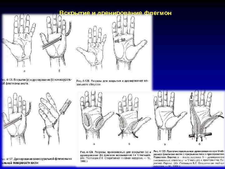 Вскрытие и дренирование флегмон 