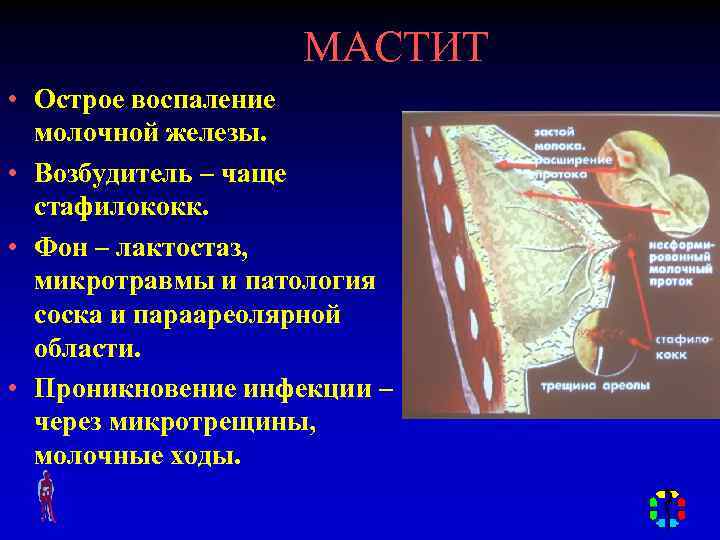 МАСТИТ • Острое воспаление молочной железы. • Возбудитель – чаще стафилококк. • Фон –