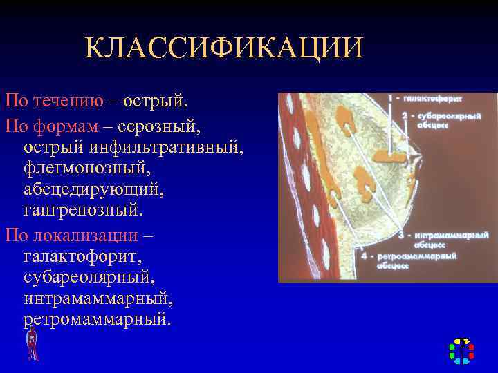 КЛАССИФИКАЦИИ По течению – острый. По формам – серозный, острый инфильтративный, флегмонозный, абсцедирующий, гангренозный.