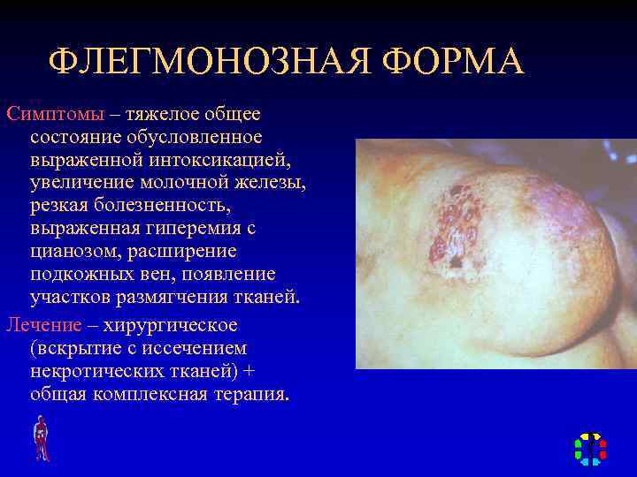 ФЛЕГМОНОЗНАЯ ФОРМА Симптомы – тяжелое общее состояние обусловленное выраженной интоксикацией, увеличение молочной железы, резкая