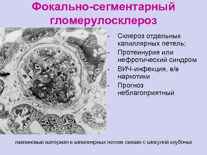 Фокально-сегментарный гломерулосклероз - Склероз отдельных капиллярных петель; Протеинурия или нефротический синдром ВИЧ-инфекция, в/в наркотики