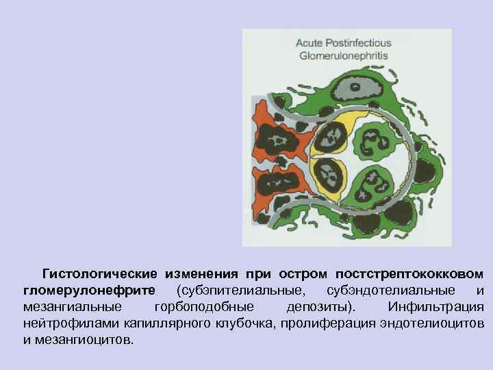  Гистологические изменения при остром постстрептококковом гломерулонефрите (субэпителиальные, субэндотелиальные и мезангиальные горбоподобные депозиты). Инфильтрация