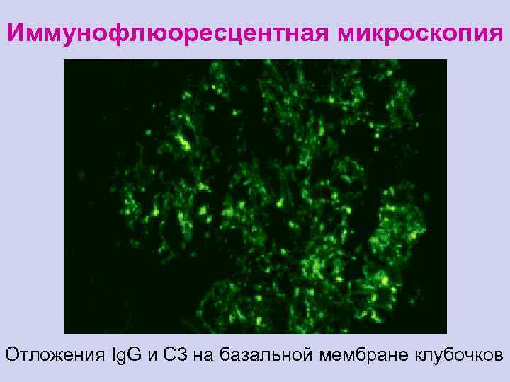 Иммунофлюоресцентная микроскопия Отложения Ig. G и C 3 на базальной мембране клубочков 