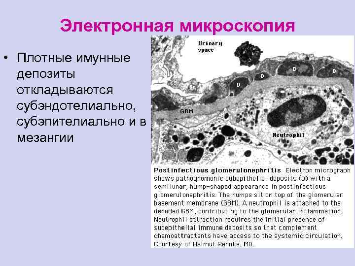 Электронная микроскопия • Плотные имунные депозиты откладываются субэндотелиально, субэпителиально и в мезангии 