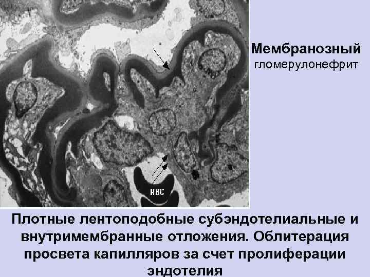 Мембранозный гломерулонефрит Плотные лентоподобные субэндотелиальные и внутримембранные отложения. Облитерация просвета капилляров за счет пролиферации