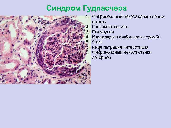 Синдром гудпасчера презентация