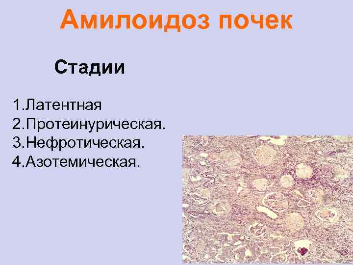 Амилоидоз почек Стадии 1. Латентная 2. Протеинурическая. 3. Нефротическая. 4. Азотемическая. 