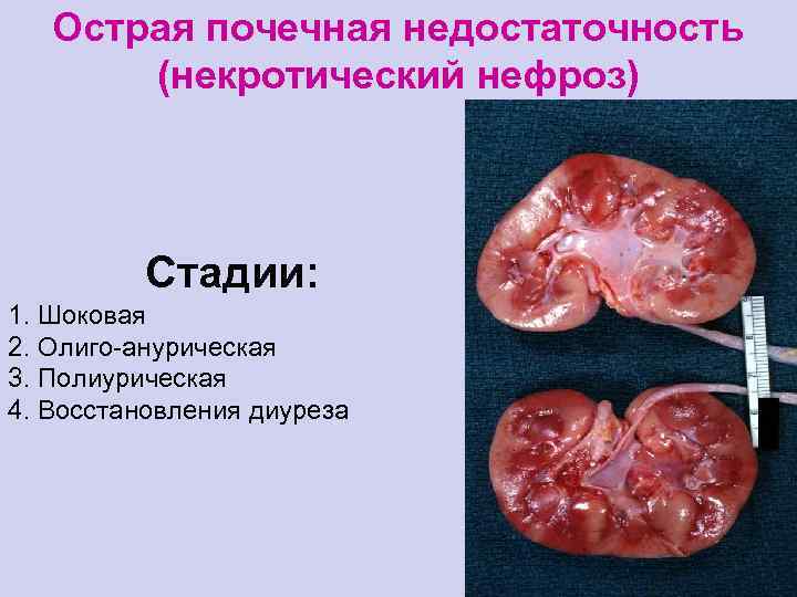 Острая почечная недостаточность (некротический нефроз) Стадии: 1. Шоковая 2. Олиго-анурическая 3. Полиурическая 4. Восстановления