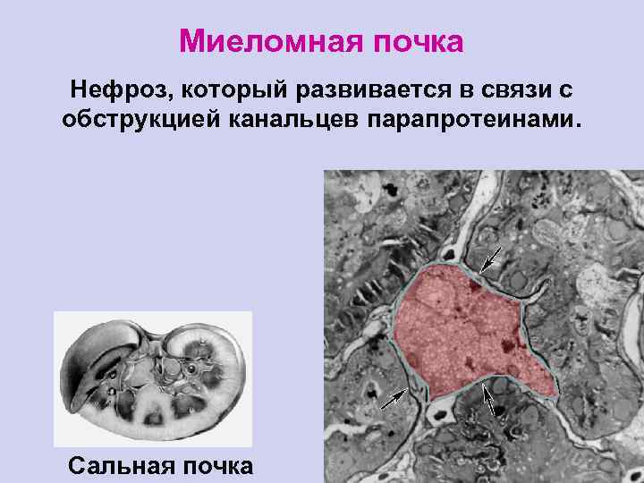 Миеломная почка Нефроз, который развивается в связи с обструкцией канальцев парапротеинами. Сальная почка 