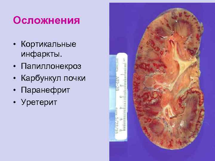 Осложнения • Кортикальные инфаркты. • Папиллонекроз • Карбункул почки • Паранефрит • Уретерит 