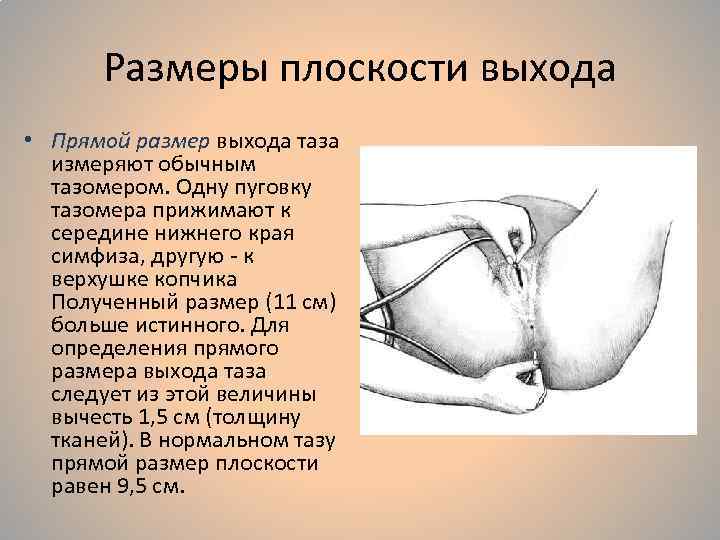 Размеры плоскости выхода • Прямой размер выхода таза измеряют обычным тазомером. Одну пуговку тазомера