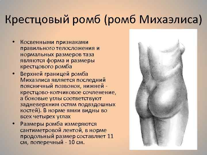 Крестцовый ромб (ромб Михаэлиса) • Косвенными признаками правильного телосложения и нормальных размеров таза являются