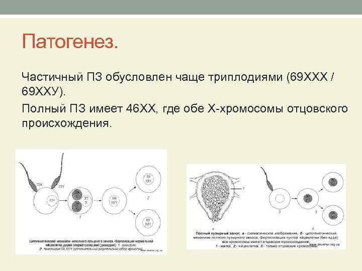 Патогенез. Частичный ПЗ обусловлен чаще триплодиями (69 ХХХ / 69 ХХУ). Полный ПЗ имеет