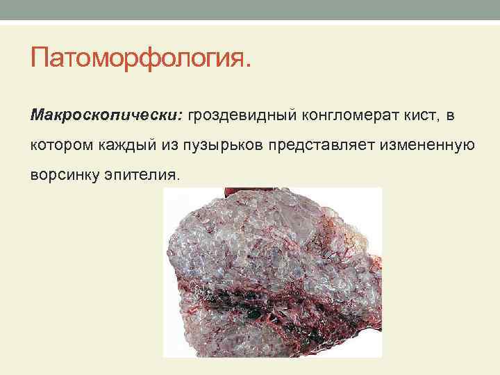 Патоморфология. Макроскопически: гроздевидный конгломерат кист, в котором каждый из пузырьков представляет измененную ворсинку эпителия.