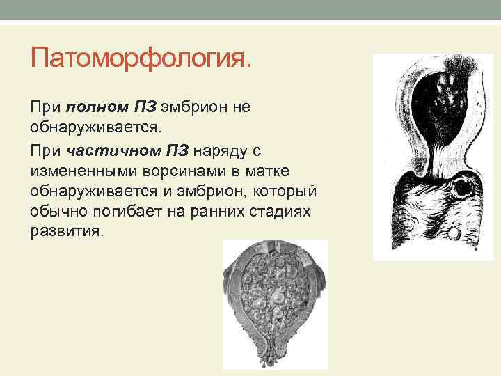 Патоморфология. При полном ПЗ эмбрион не обнаруживается. При частичном ПЗ наряду с измененными ворсинами