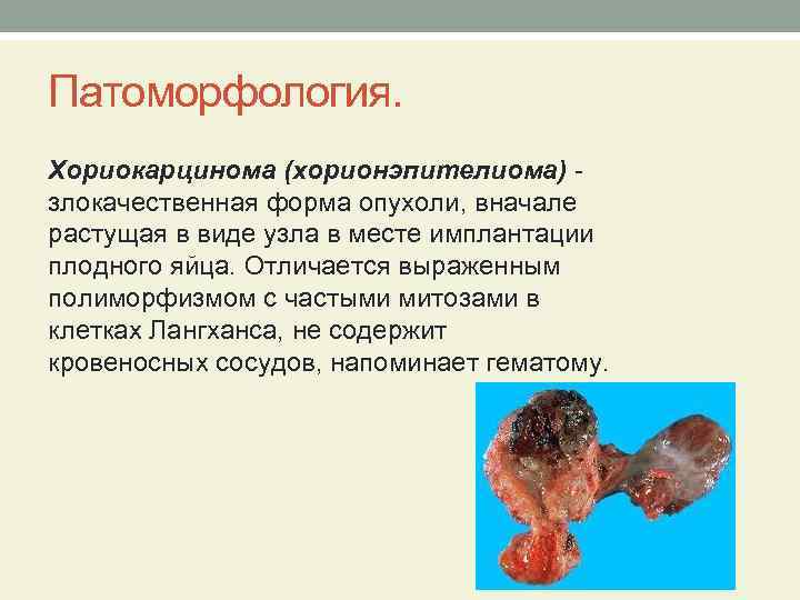 Патоморфология. Хориокарцинома (хорионэпителиома) злокачественная форма опухоли, вначале растущая в виде узла в месте имплантации