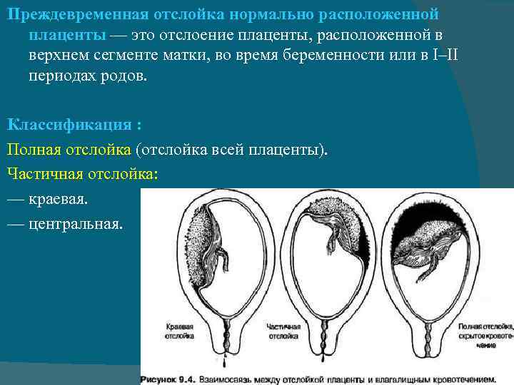 Тест предлежание плаценты