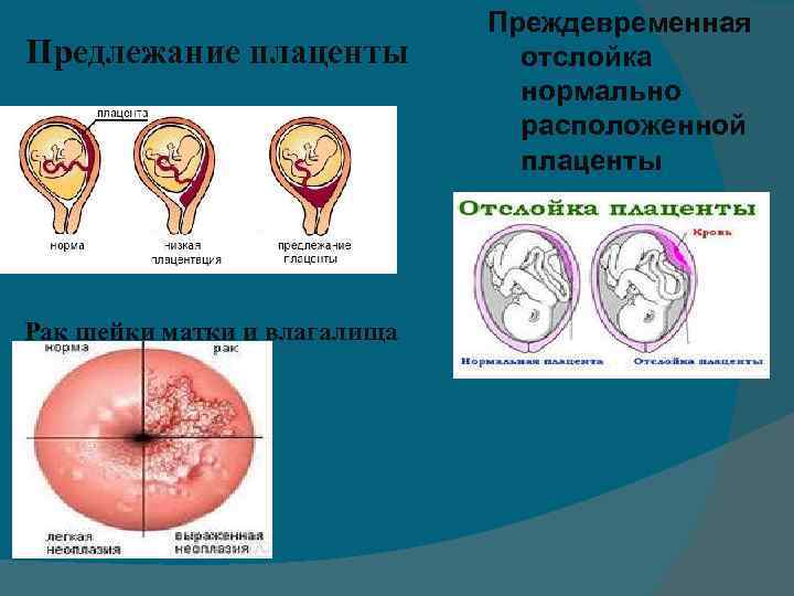 Зев шейки матки закрыт. Краевое и центральное предлежание плаценты. Плацента перекрывает шейку матки.