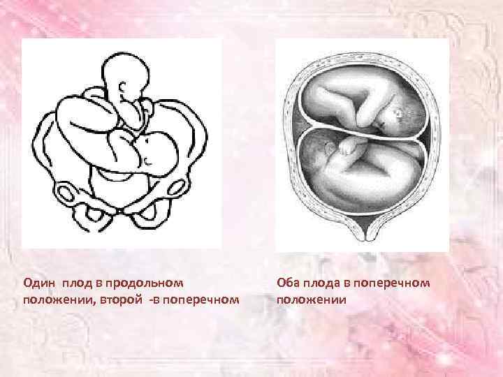 Один плод в продольном положении, второй -в поперечном Оба плода в поперечном положении 