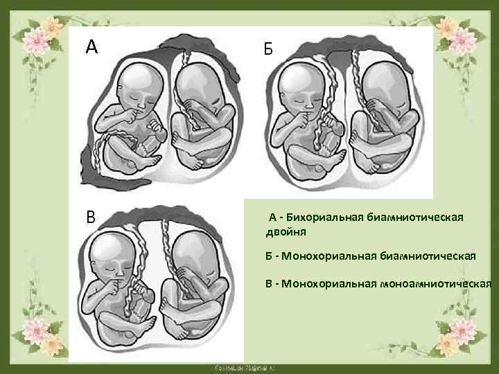 А В Б А - Бихориальная биамниотическая двойня Б - Монохориальная биамниотическая В -