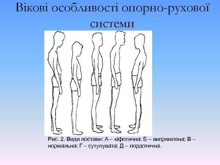 Вікові особливості опорно-рухової системи Рис. 2. Види постави: А – кіфотична; Б – випрямлена;