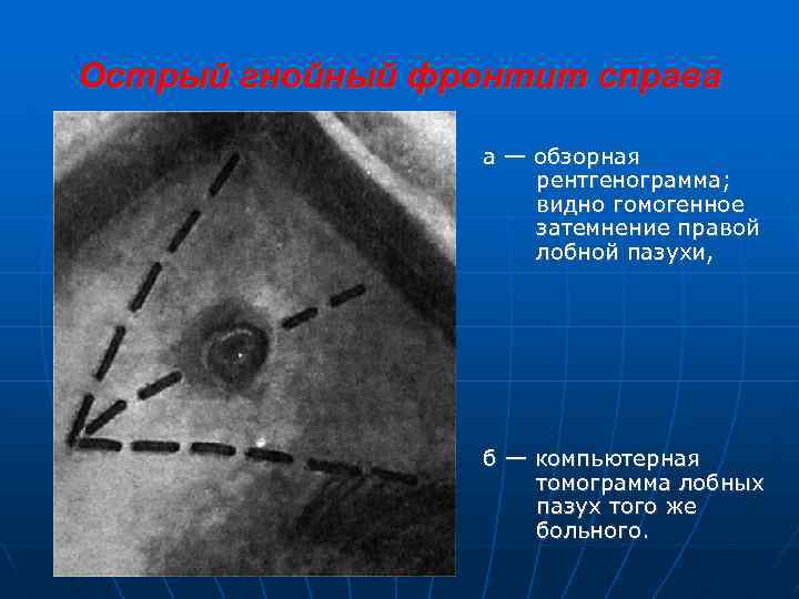 Острый гнойный фронтит справа а — обзорная рентгенограмма; видно гомогенное затемнение правой лобной пазухи,
