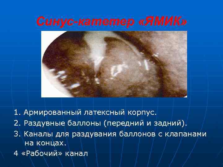 Синус-катетер «ЯМИК» 1. 2. 3. Армированный латексный корпус. Раздувные баллоны (передний и задний). Каналы