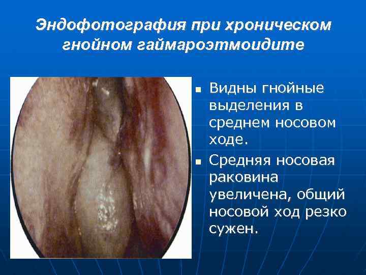 Эндофотография при хроническом гнойном гаймароэтмоидите Видны гнойные выделения в среднем носовом ходе. Средняя носовая